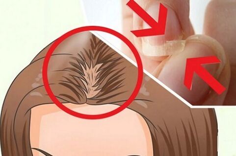Problemas con el cabello y las uñas debido a parásitos.
